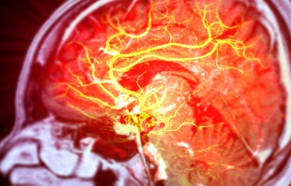 Dua Jenis Stroke, Dua Cerita Berbeda